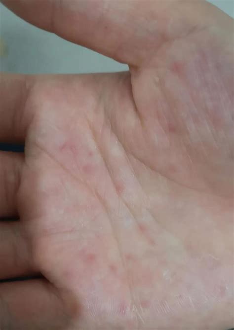 「汗疱疹」如何根治？它与湿疹的关系？与手足癣的区别？都解答在这里了！