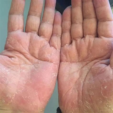 手掌脱皮瘙痒，留心4种病“作祟”|手癣|汗疱疹|脱皮_新浪新闻