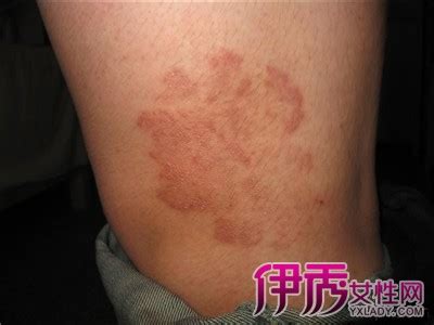 圆癣初期图片