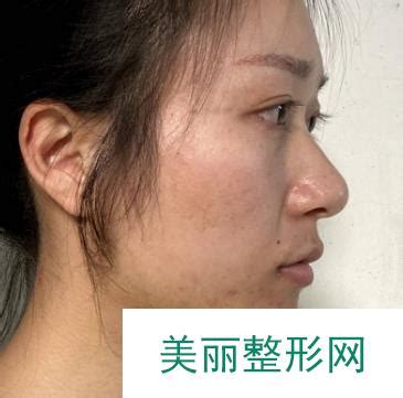 西京医院整形外科双眼皮手术【价格表】，还有案例前后对比_美嘉整形网(美学知识)