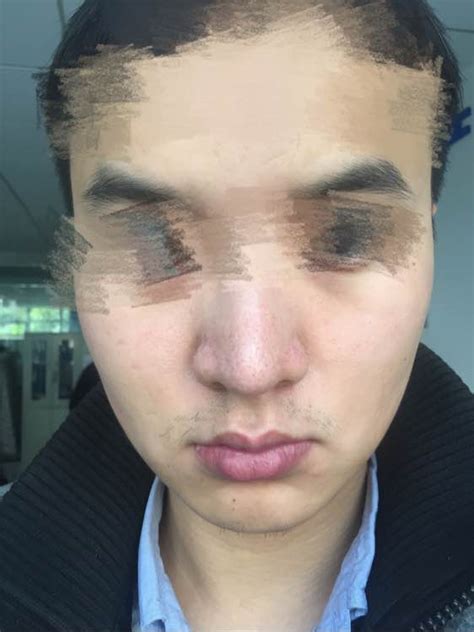 酒糟鼻图片