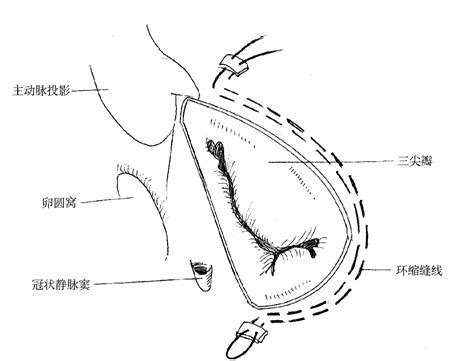 图5-9 心室肌层次(左心室前外侧面观)-基础医学-医学