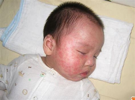 常见湿疹分为五种类型图片，汗疱疹/钱币疱疹/干性湿疹(都瘙痒) — 神奇养生网