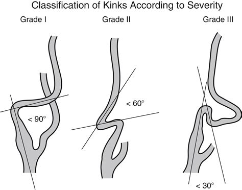 Carotid Artery Kinks and Coils | Thoracic Key