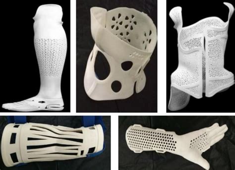 上海医院研发“定制式增材制造膝关节矫形器”获二类医疗器械注册-aau3d打印