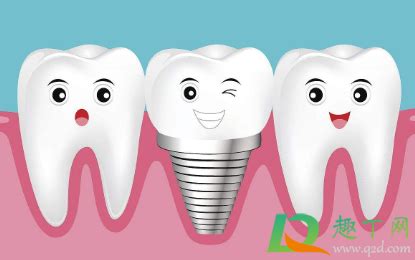 种植牙齿多少钱一个-种植牙齿能保持多少年-种植牙的五大危害
