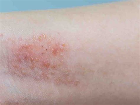 红色斑丘疹的预防与治疗-色斑治疗-复禾健康