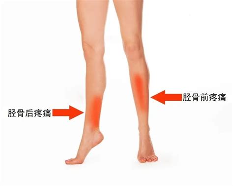 小腿酸疼怎么缓解？|小腿|酸疼|缓解|局部|酸痛|乳酸|治疗|-健康界