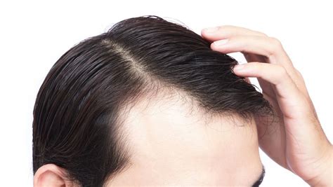 科学家：补充一种益生菌或能避免脱发并拯救“秃头” - 知乎