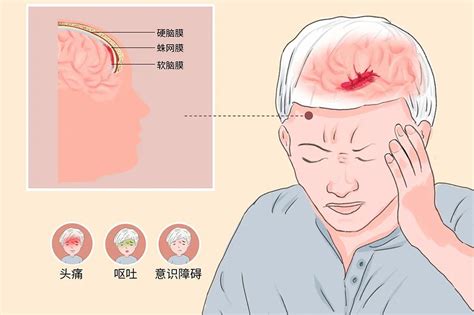美国FDA批准首个发作性丛集性头痛疗法 - 知乎