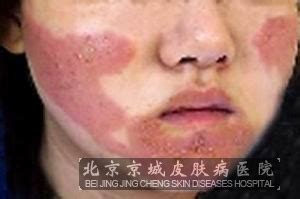 过敏性皮炎的图片