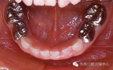 关于牙齿矫正，看这一篇就够了 - 愈大夫科普网