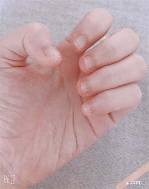 手指脱皮是什么原因 （手指脱皮怎么治疗） | 说明书网