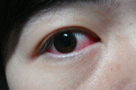 过敏性结膜炎眼睛红肿图片_有来医生