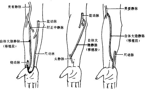 动静脉内瘘图片