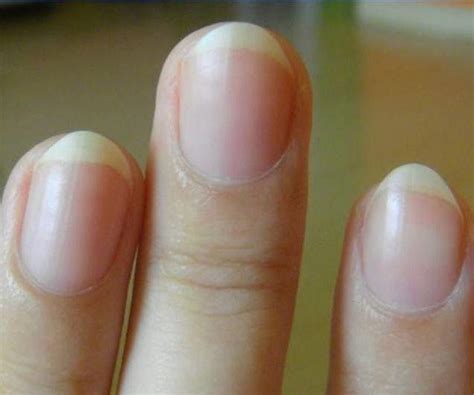 孩子手指月牙白越多，就越健康？看看你家孩子手指上有吗？