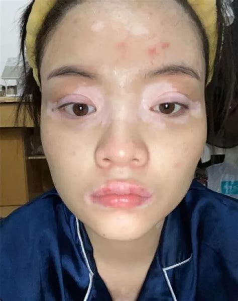 脸部癜风图片