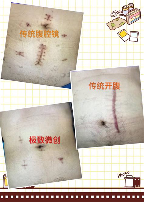 直肠脱垂图片