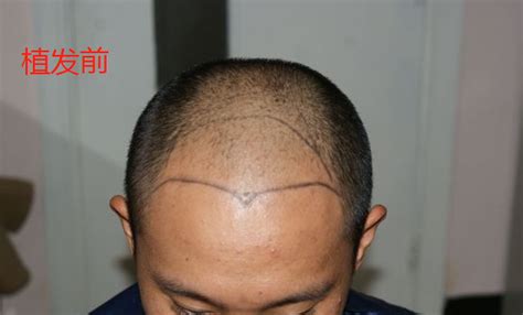 【图】人可以种植头发吗？ 介绍头发种植术的3个步骤(2)_可以种植头发吗_伊秀美容网|yxlady.com