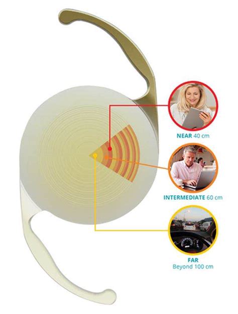 宜昌首例PanOptix三焦点人工晶状体植入手术在爱尔眼科成功开展 - 三峡宜昌网