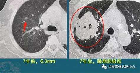 磨玻璃肺结节到晚期肺癌随访4种结局|肺癌|结节|结局_新浪新闻