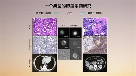 大肠癌的早、中、晚期是如何分类的__凤凰网