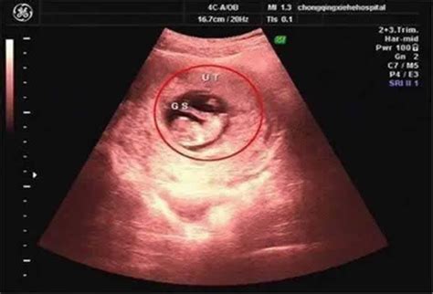双胞胎孕囊_意外中了双胞胎，42天的B超图，有会看孕囊形状的_宝宝树