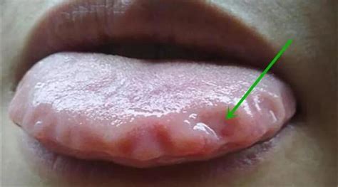 舌诊浅析：舌头有齿痕，舌面裂纹以及舌尖红点