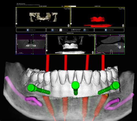 3D数字化导板技术 - 为何能称为种植牙手术中的“大梁”？__凤凰网