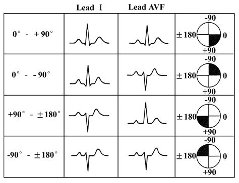 心电图qrs电轴正常值,不正常的心电图单,心电图st段_大山谷图库