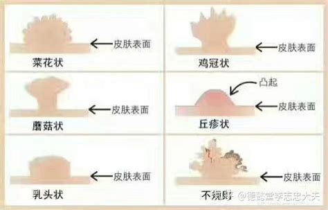 病毒疣图片