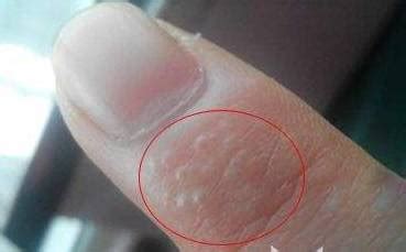 【小水泡】【图】手上长小水泡的原因有哪些 盘点手上水泡的特征(2)_伊秀健康|yxlady.com