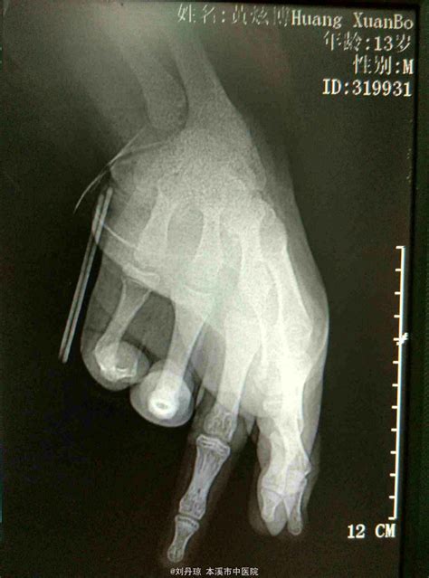 左第5指近节指骨骨折-医联