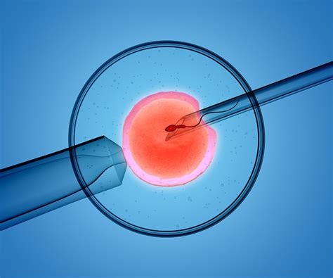 人工授精的精子是怎么取的-深圳中山泌尿外科医院