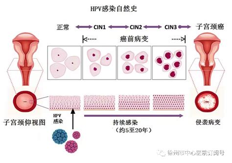 徐州市中心医院妇产科孙芳：宫颈癌是可以预防的癌症 - 全程导医网