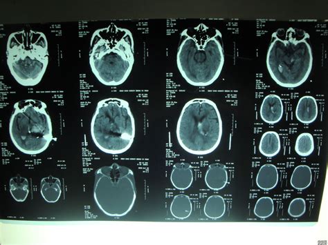 脑出血-名医解读CT-医学