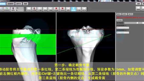 锁骨骨折固定3D动画演示钉板系统针植入物钉板系统、针、植入物_腾讯视频