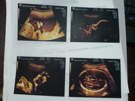 彩超单看胎儿性别，专家进 孕期，将近12周 - 百度宝宝知道