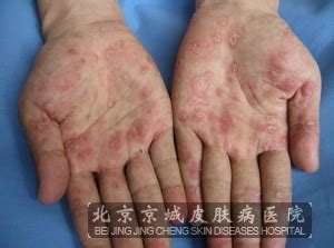 梅毒的症状有哪些呢_梅毒_北京京城皮肤医院(北京医保定点机构)