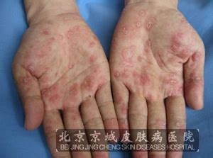 梅毒红斑图片