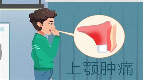 口腔上颚溃疡图片