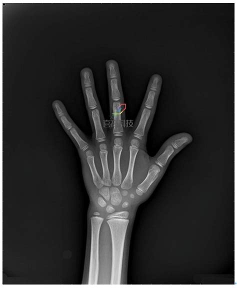 骨龄鉴定_骨龄测评_人工智能骨龄软件—喜高科技公司