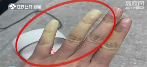 浙江一23岁小伙手指末端肿大就像“青蛙趾”，病源竟然在妈妈身上？