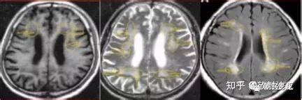 颅脑MR脑白质高信号是缺血灶吗？ - 知乎