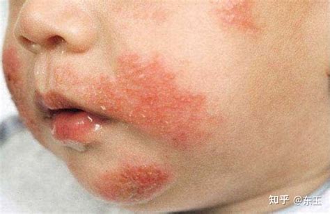 宝宝皮肤病与湿疹如何区分？怎么治疗呢？ - 知乎