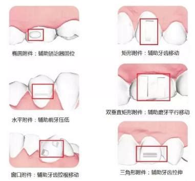 小科普之隐形牙套上的附件作用是啥你造吗？ - 口腔资讯 - 牙齿矫正网