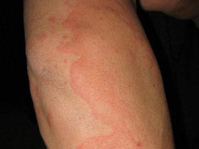 【螨虫引起的荨麻疹】【图】螨虫引起的荨麻疹 带你了解丘疹性荨麻疹发病的真正原因(3)_伊秀健康|yxlady.com
