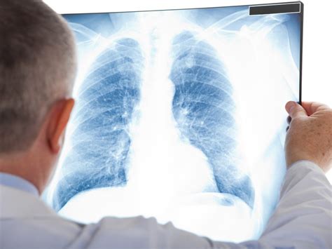 高危肺栓塞+血小板重度减少，该如何处理？_医学界-助力医生临床决策和职业成长