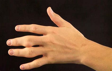 右手无名指和小拇指麻木是什么原因-有来医生