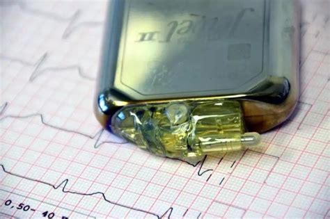 科技改变医疗：新型心脏起搏器让患者受益_环球医疗器械网